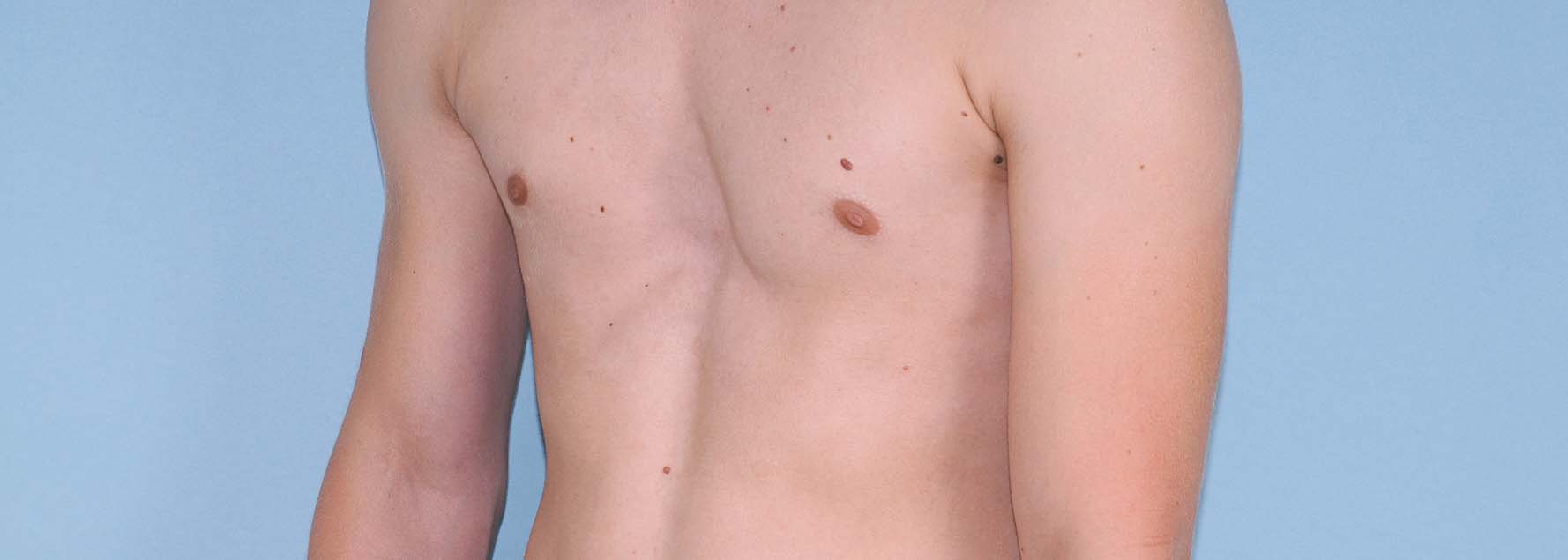 Brustwand_Fehlbildung4 (2)