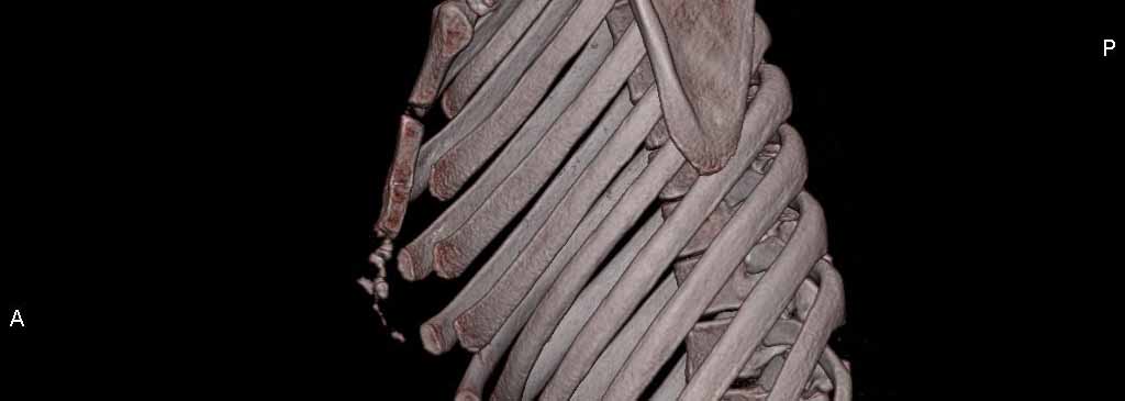 brustwand_Fehlbildung2