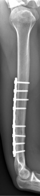 Oberarmschaftbruch5