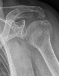 Proximaler Oberarmbruch3