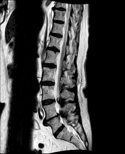 Spinalkanalstenose I Spinalkanalstenose I