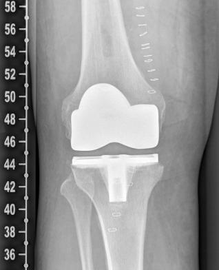 Röntgenbild nach OP von vorn